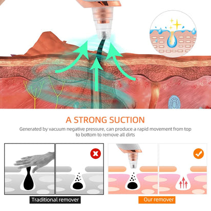 Blackhead Remover Machine™