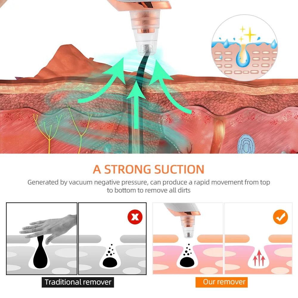 Blackhead Remover Machine™